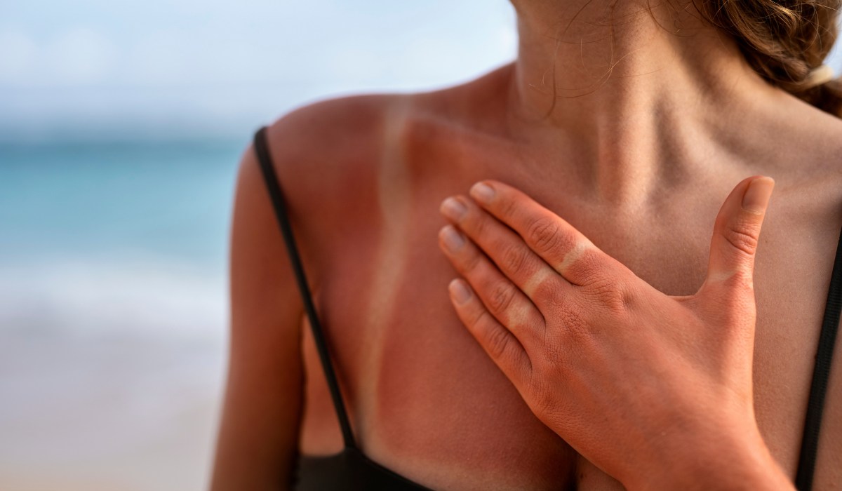 Quemaduras de sol, prevención y tratamiento